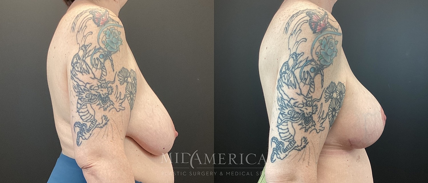 Breast Lift Before & After