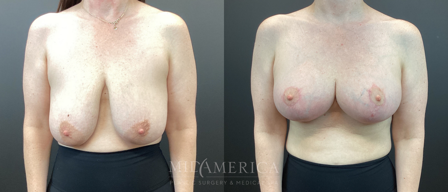 Breast Lift Before & After