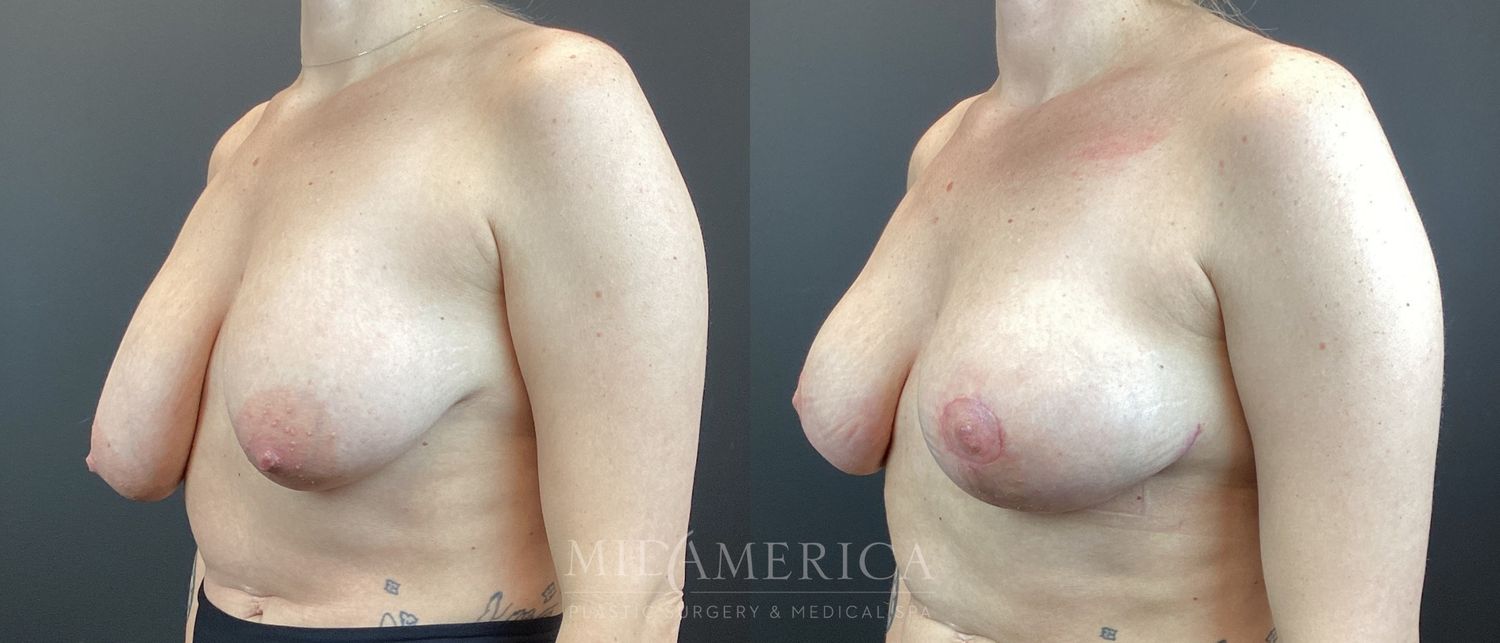 Breast Lift Before & After