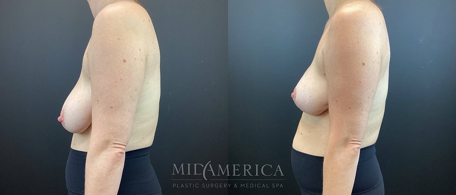 Breast Lift Before & After