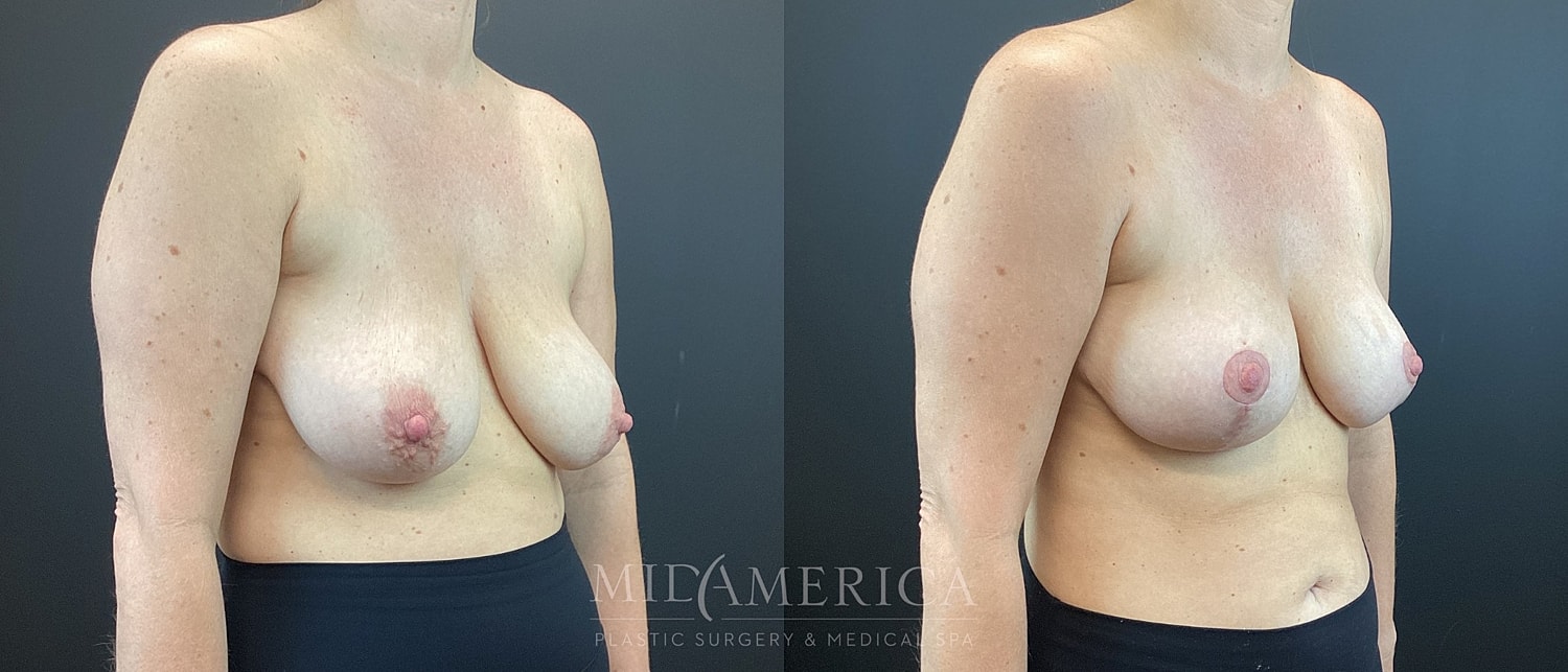 Breast Lift Before & After