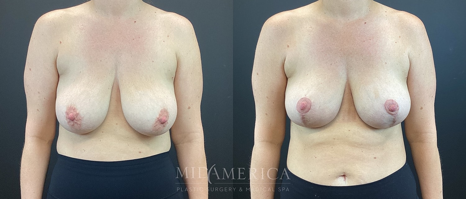Breast Lift Before & After