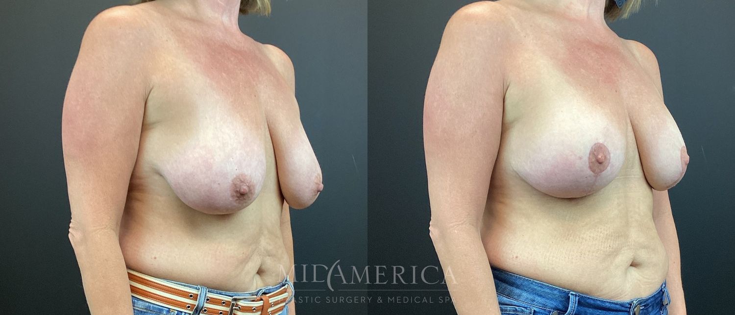 Breast Lift Before & After