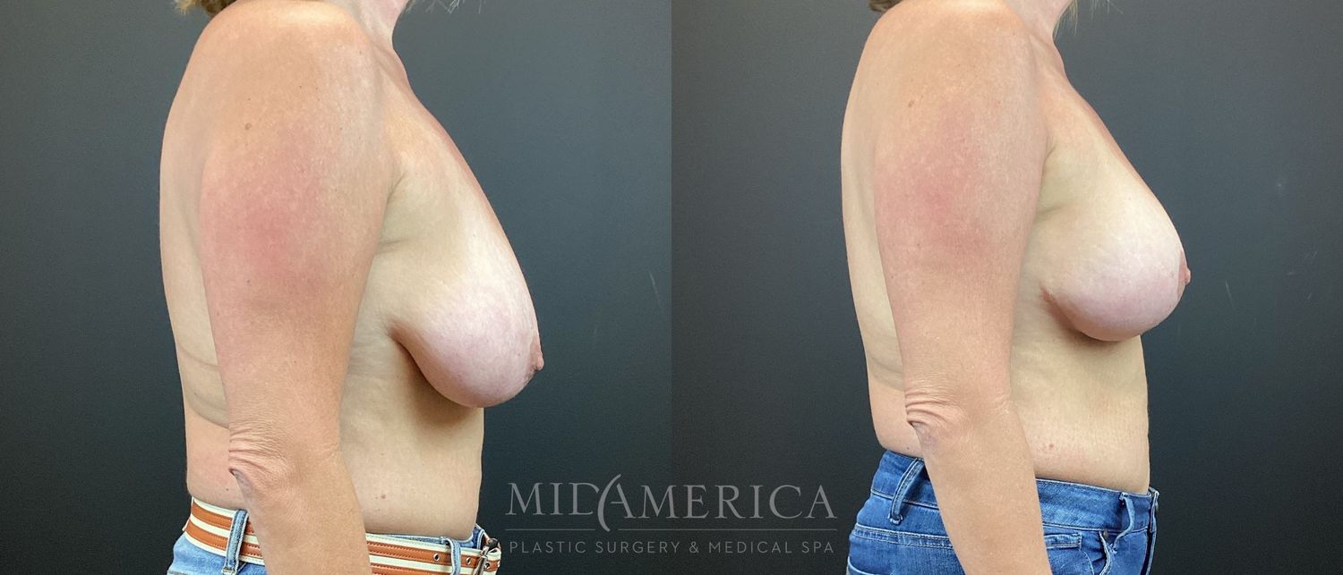 Breast Lift Before & After