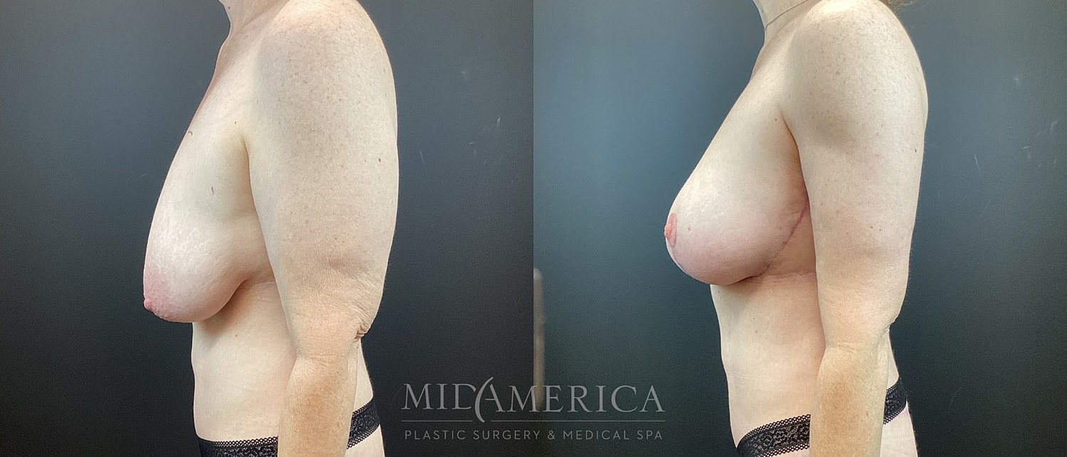 Before and after breast enhancement surgery comparison.
