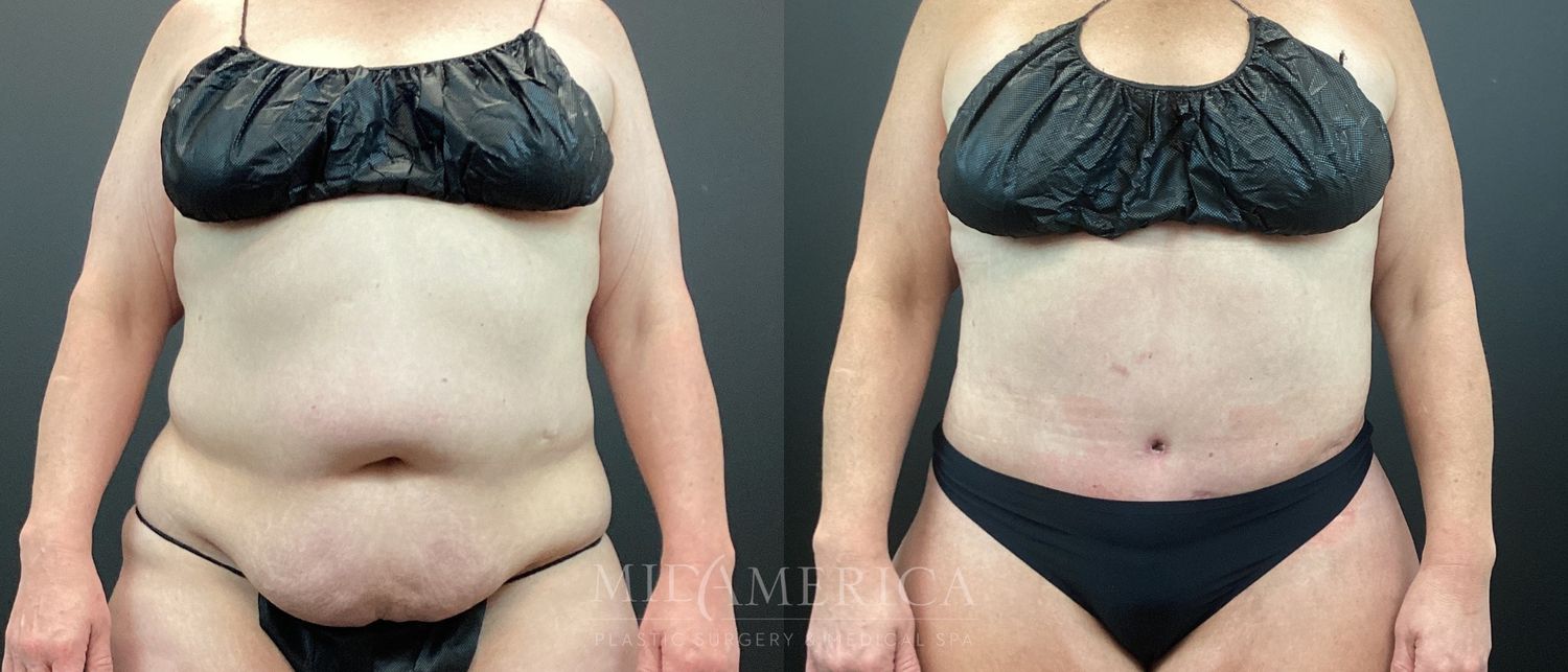 Belt Lipectomy  Before & After
