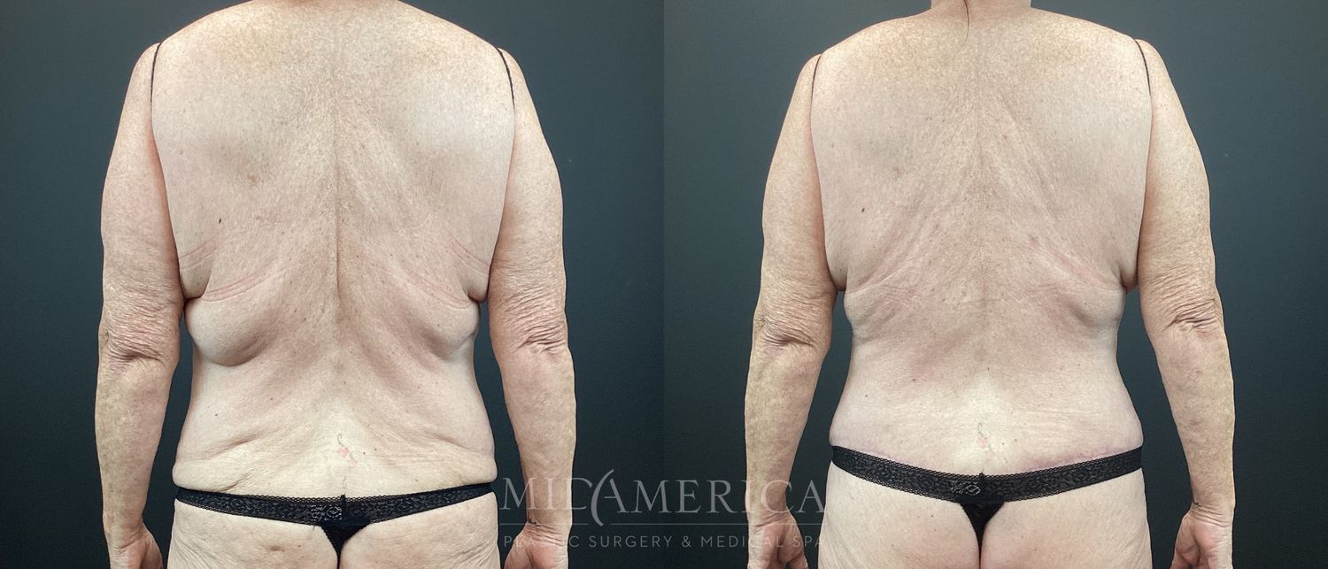 Belt Lipectomy  Before & After
