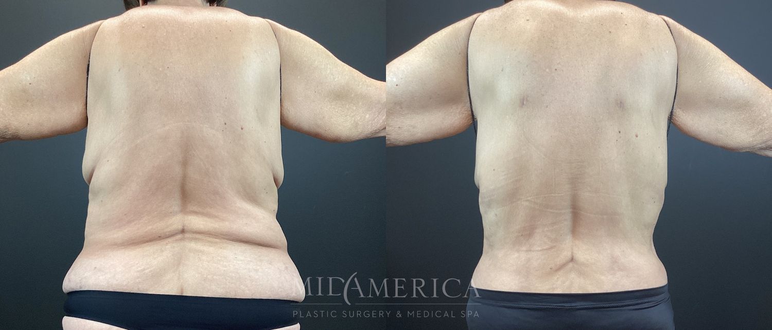 Belt Lipectomy  Before & After