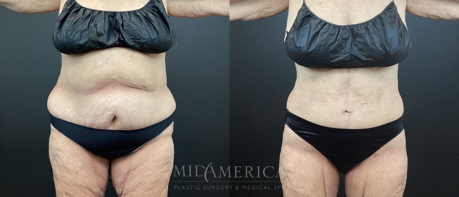 Belt Lipectomy  Before & After