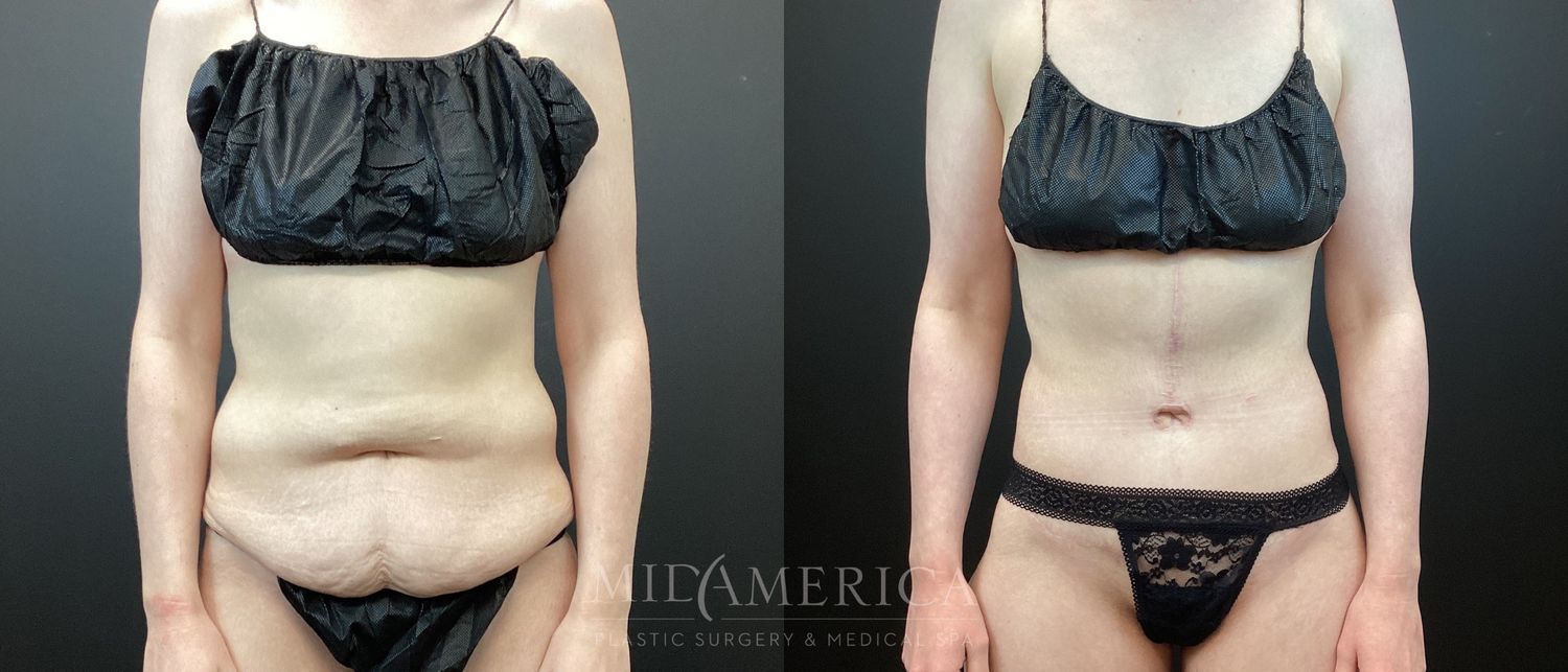 Belt Lipectomy  Before & After