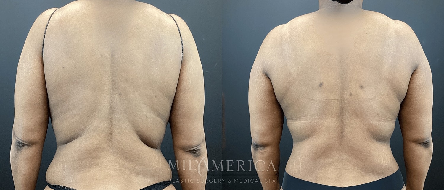 Belt Lipectomy  Before & After