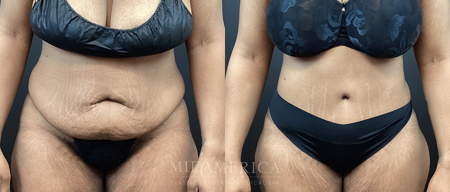 Belt Lipectomy  Before & After