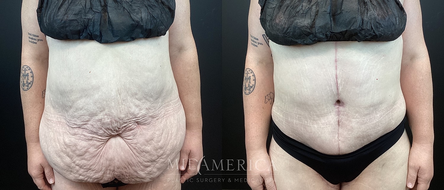 Before and after body contouring procedure images