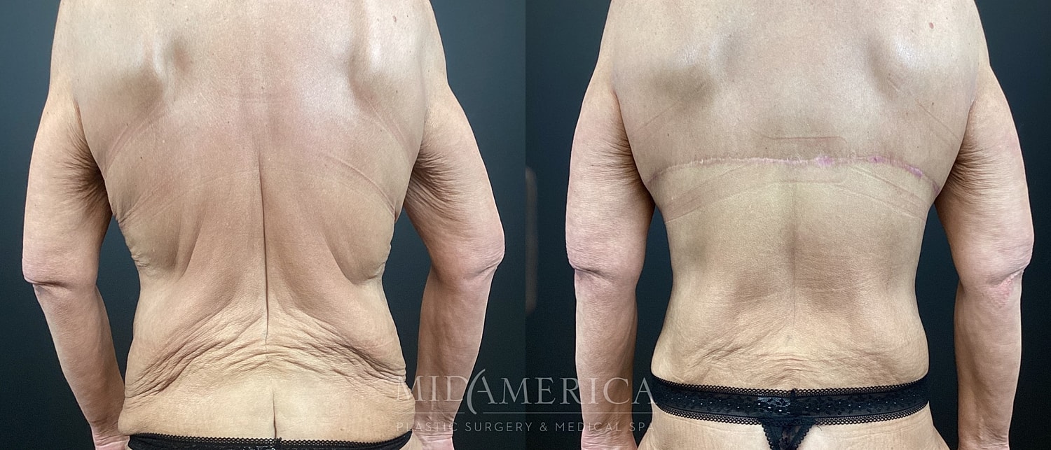 Before and after surgery back view comparison