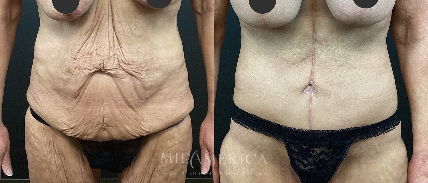 Before and after body contouring results.