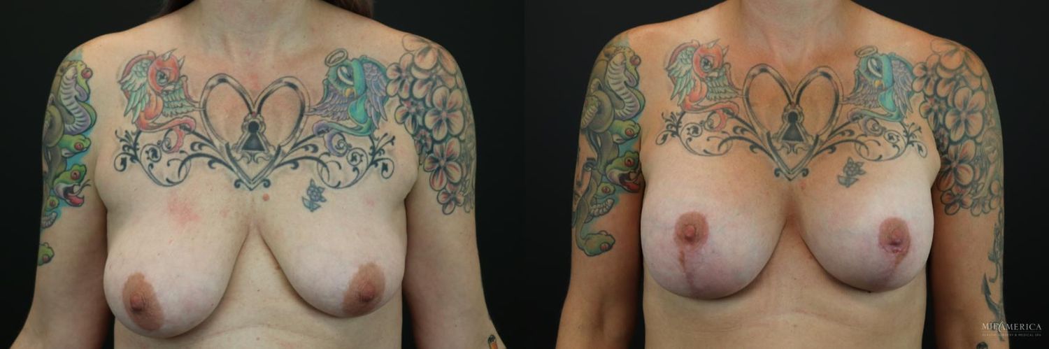 Breast Augmentation & Lift Before & After