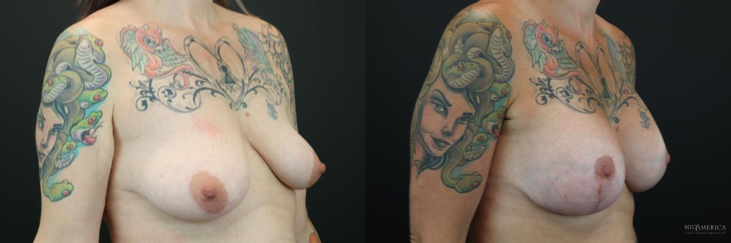 Breast Augmentation & Lift Before & After
