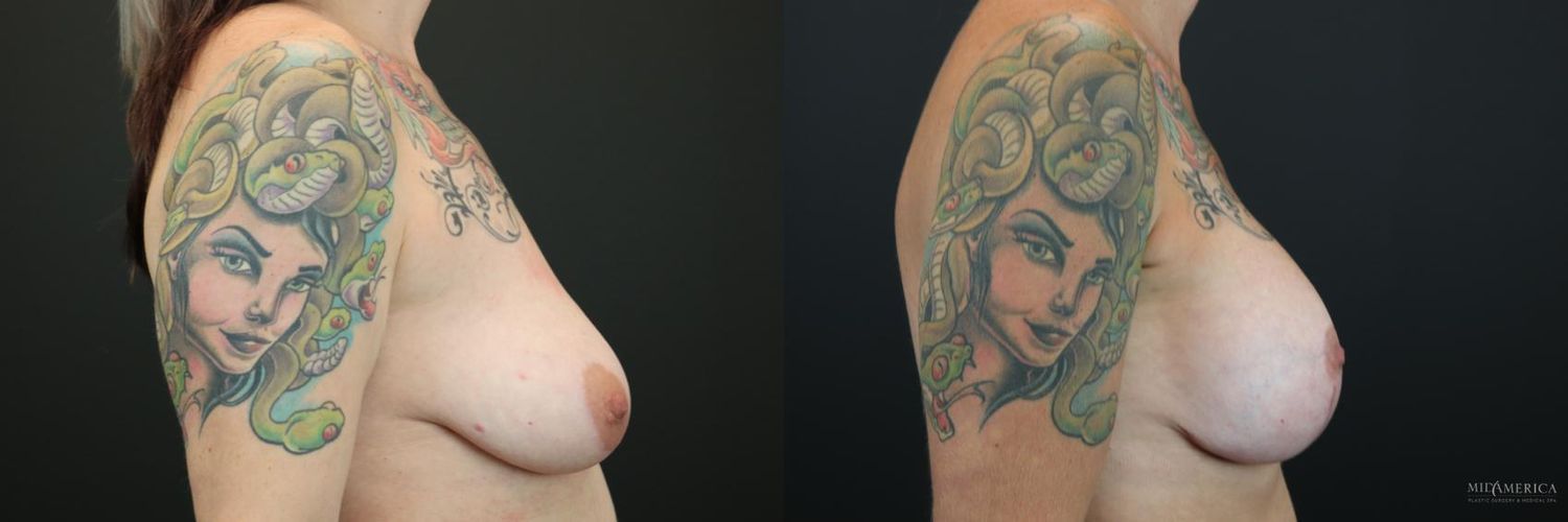 Breast Augmentation & Lift Before & After