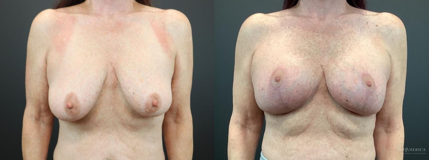 Breast Augmentation & Lift Before & After