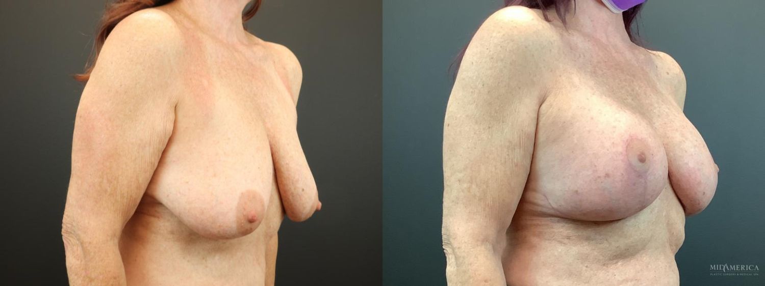 Breast Augmentation & Lift Before & After