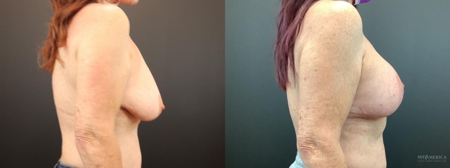 Breast Augmentation & Lift Before & After