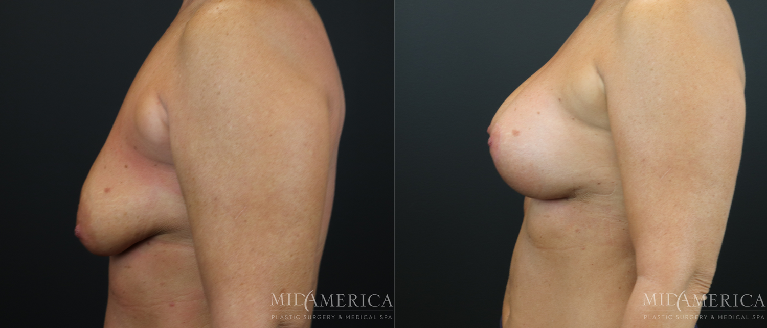 Breast Augmentation & Lift Before & After