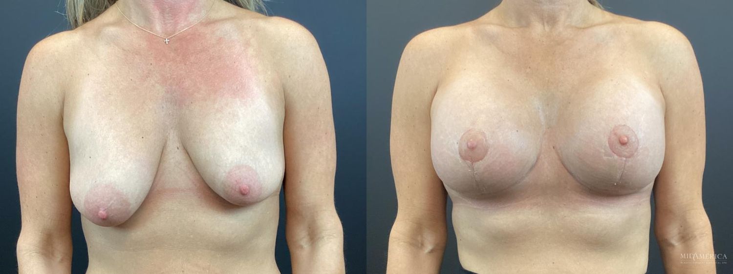 Breast Augmentation & Lift Before & After