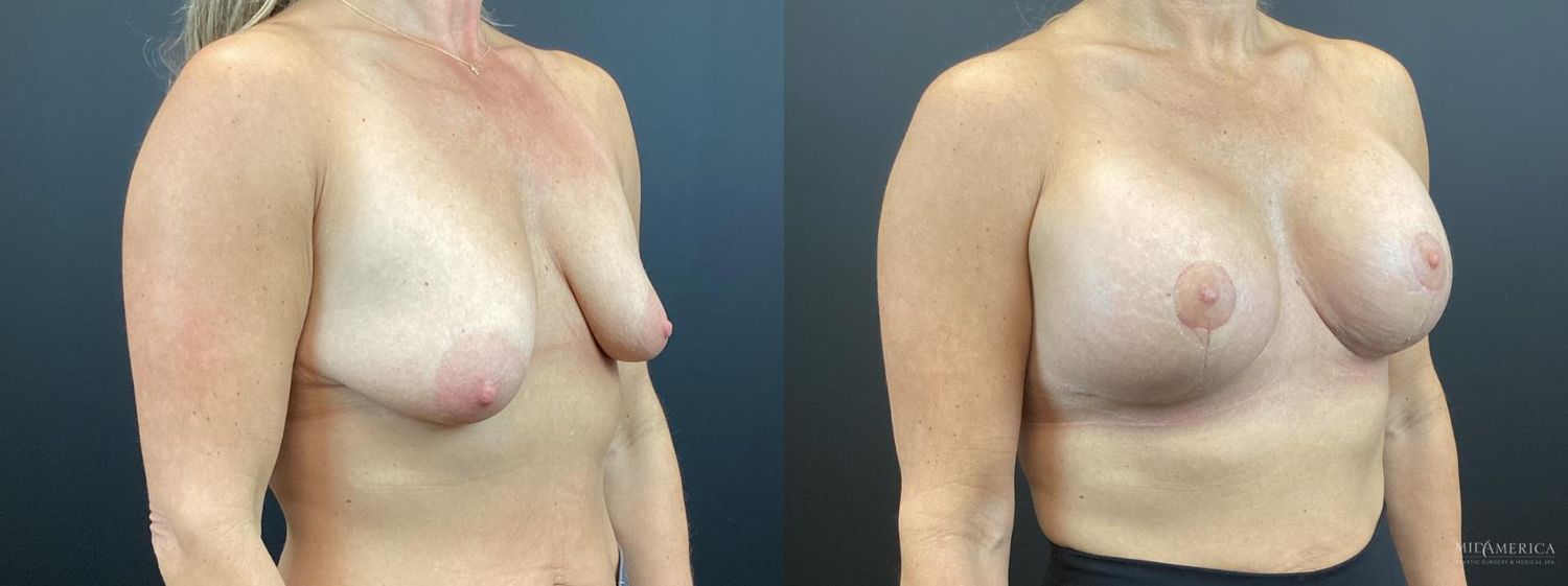 Breast Augmentation & Lift Before & After