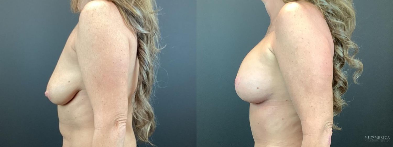 Breast Augmentation & Lift Before & After