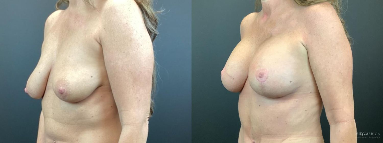 Breast Augmentation & Lift Before & After