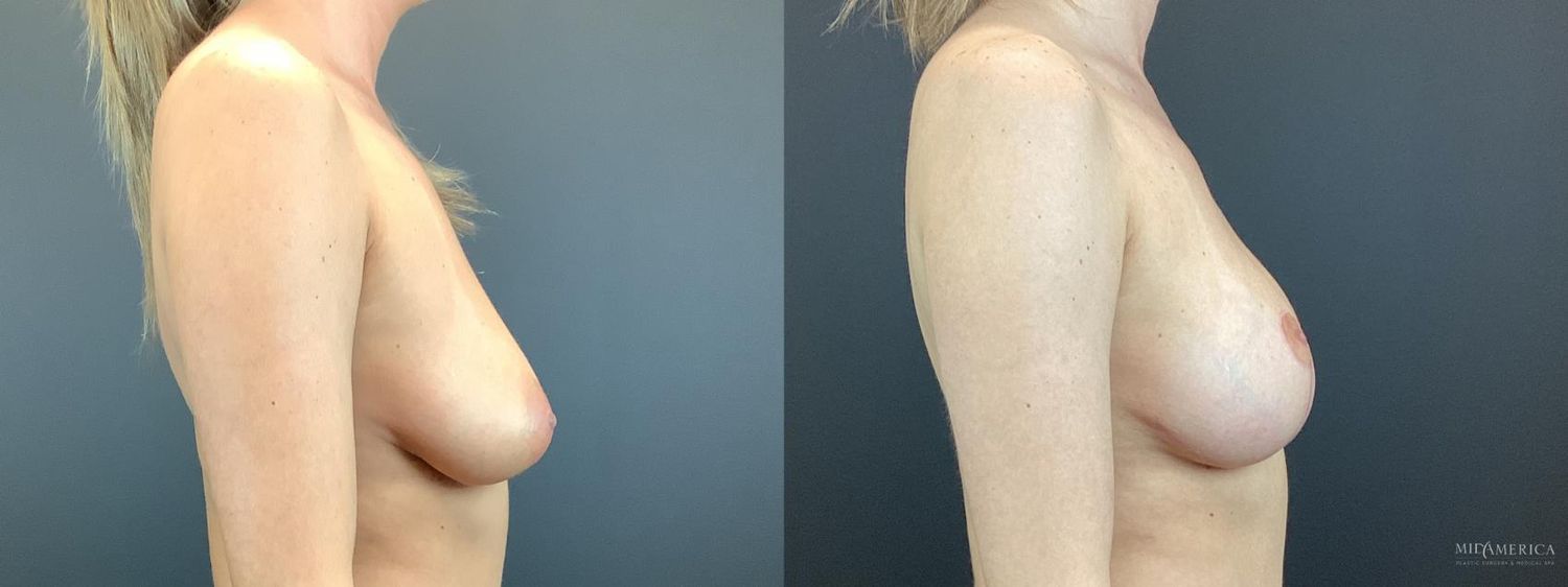 Breast Augmentation & Lift Before & After