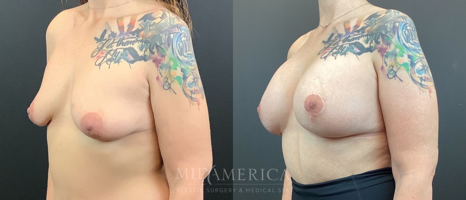 Breast Augmentation & Lift Before & After