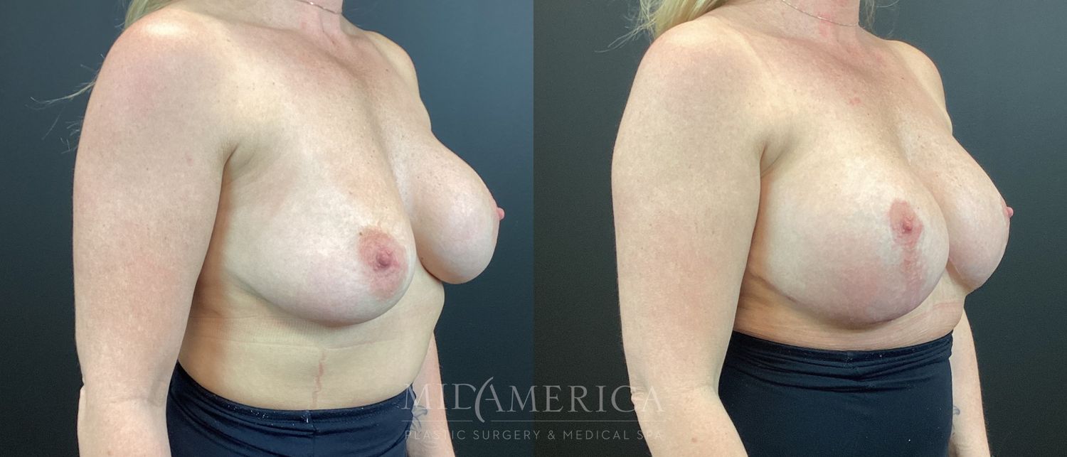 Breast Augmentation & Lift Before & After