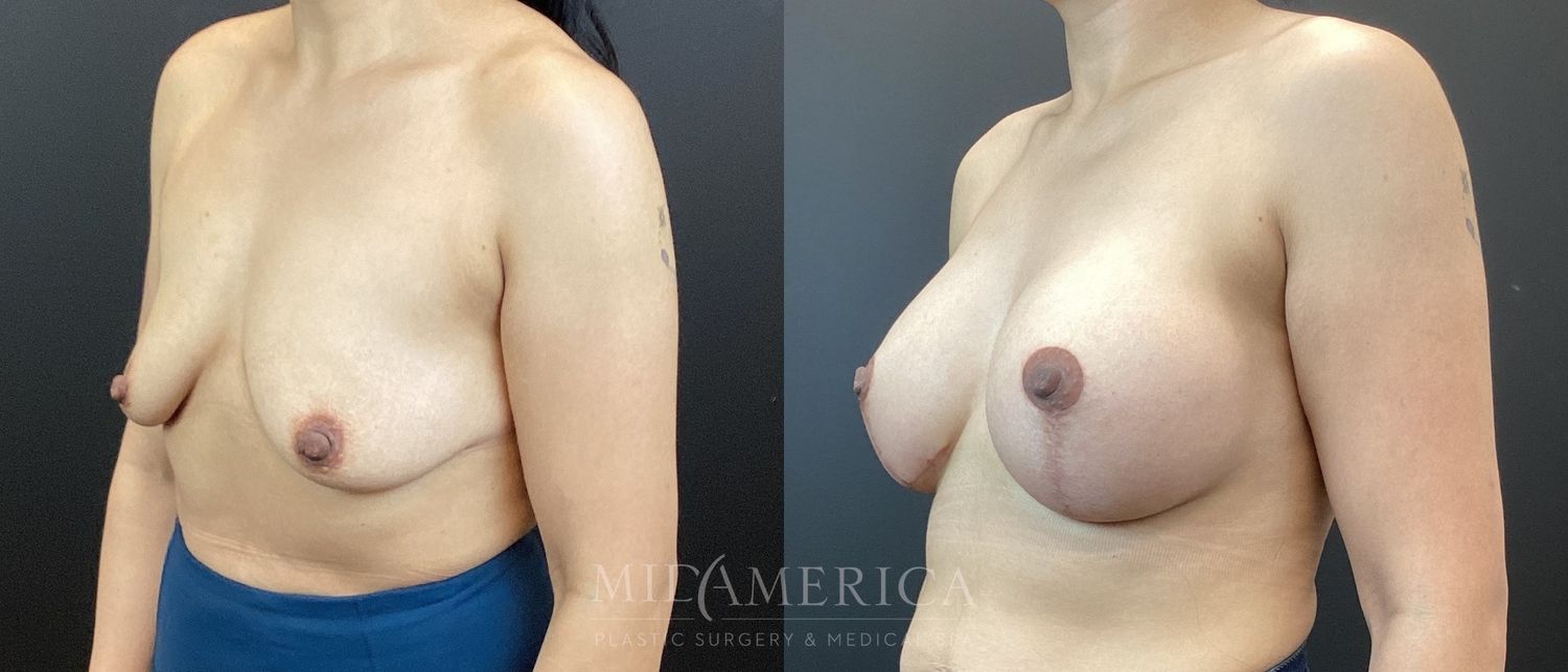 Breast Augmentation & Lift Before & After