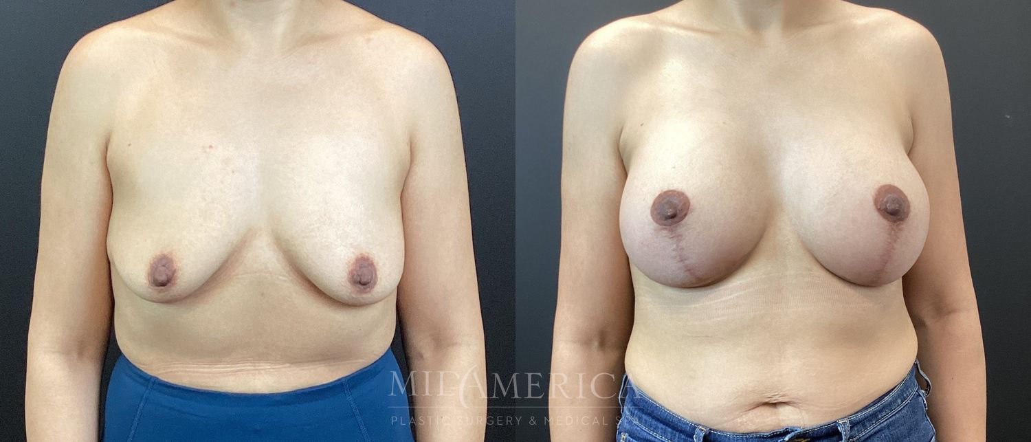 Breast Augmentation & Lift Before & After