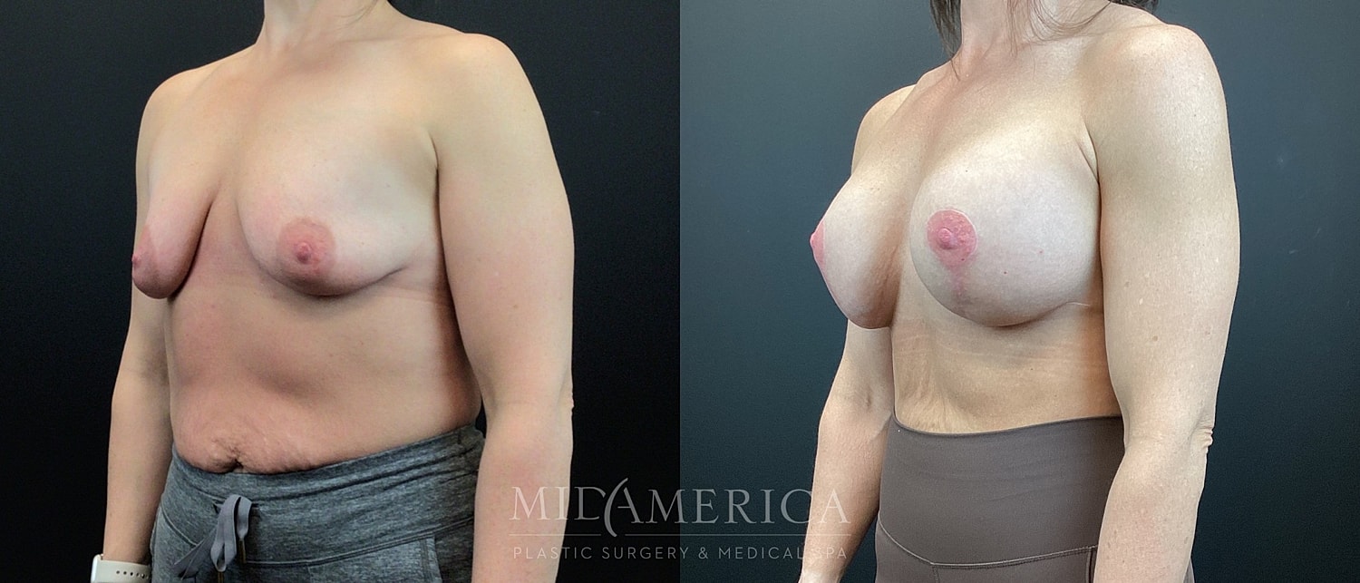 Before and after plastic surgery transformation image.