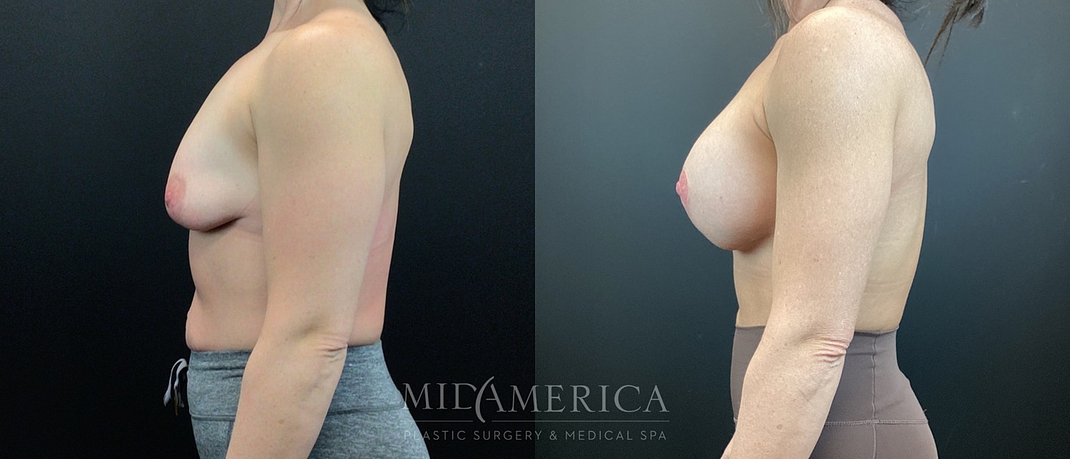 Before and after breast enhancement comparison.