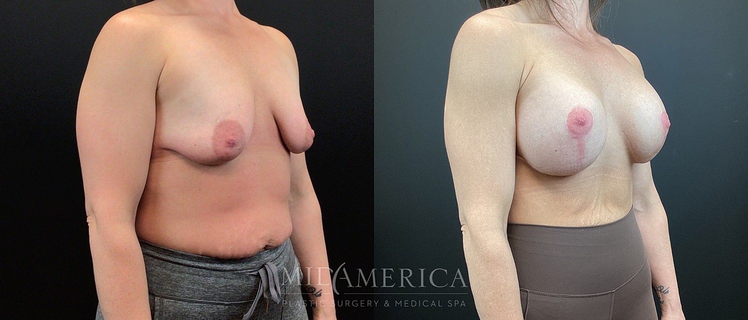 Before and after breast augmentation photos.