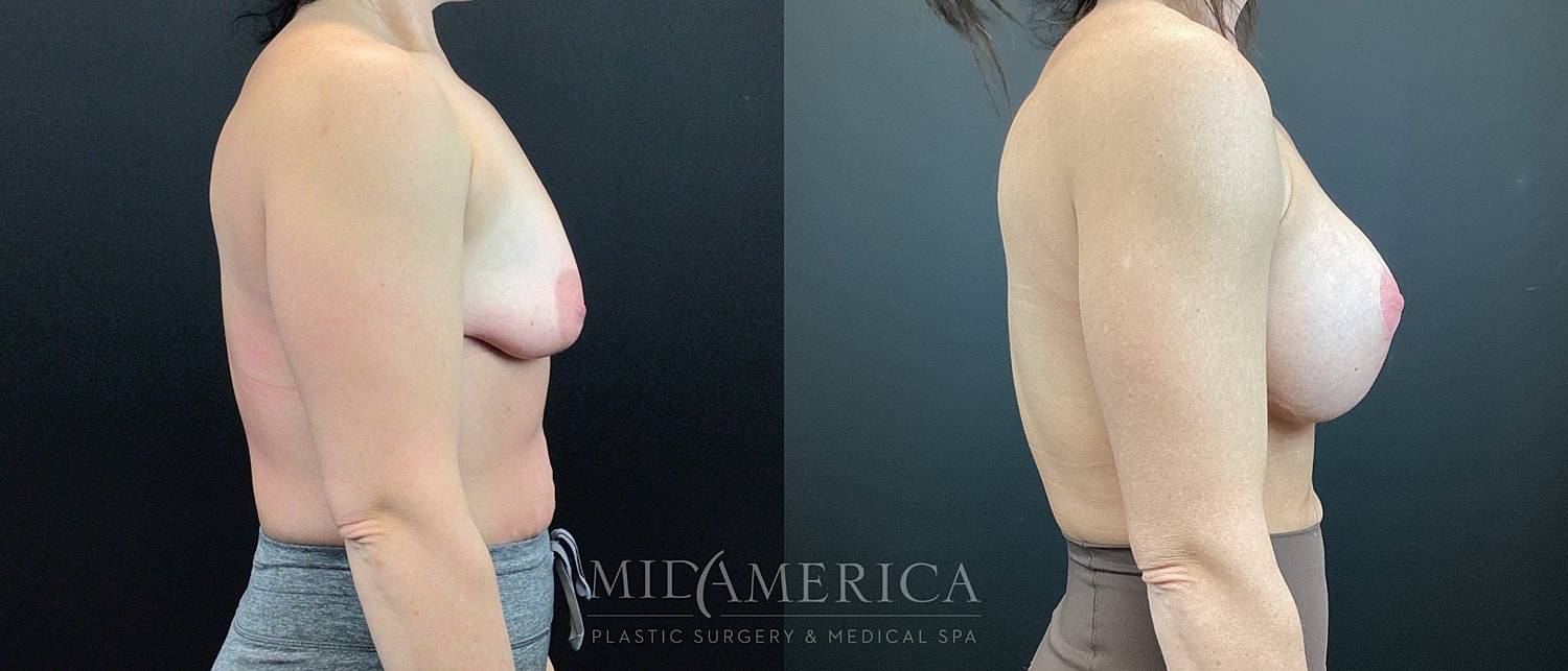 Before and after breast enhancement procedure comparison.