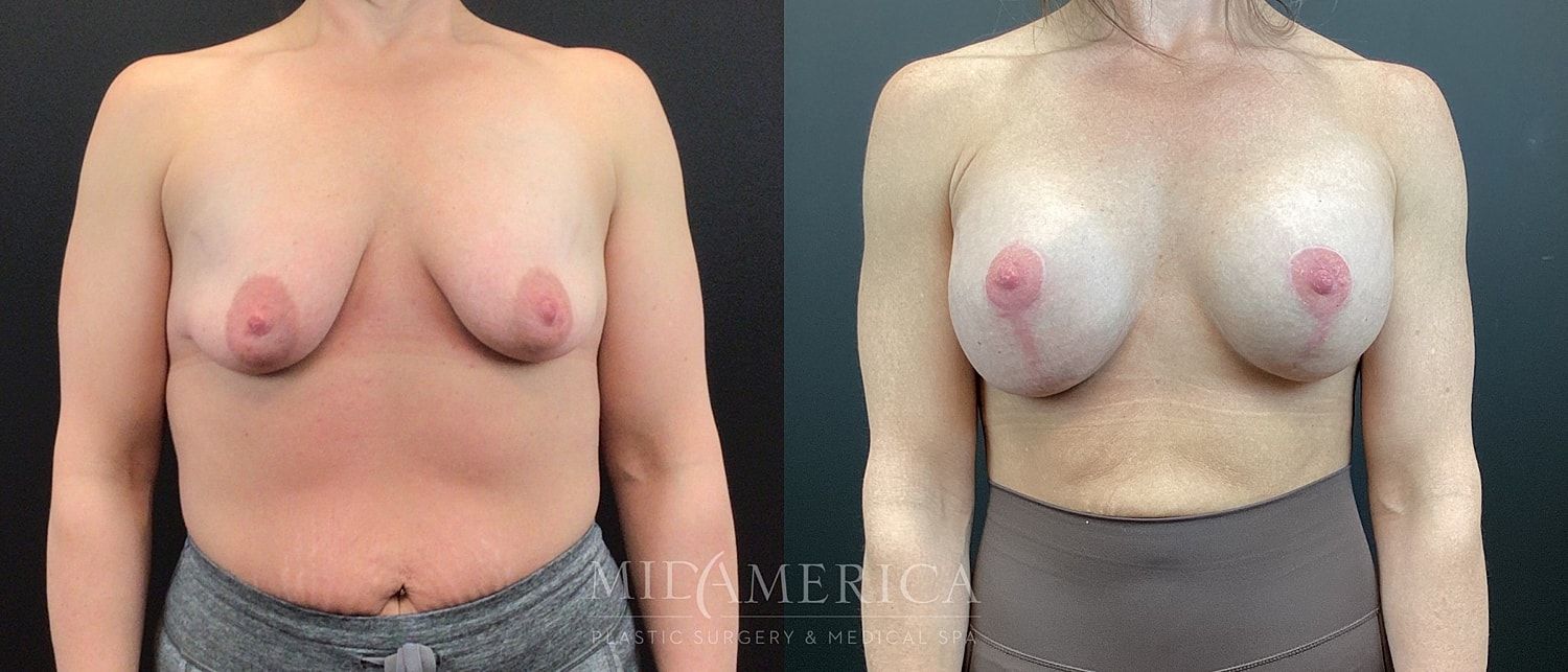 Before and after breast augmentation transformation.