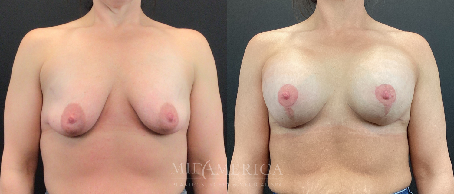 Breast Augmentation & Lift Before & After