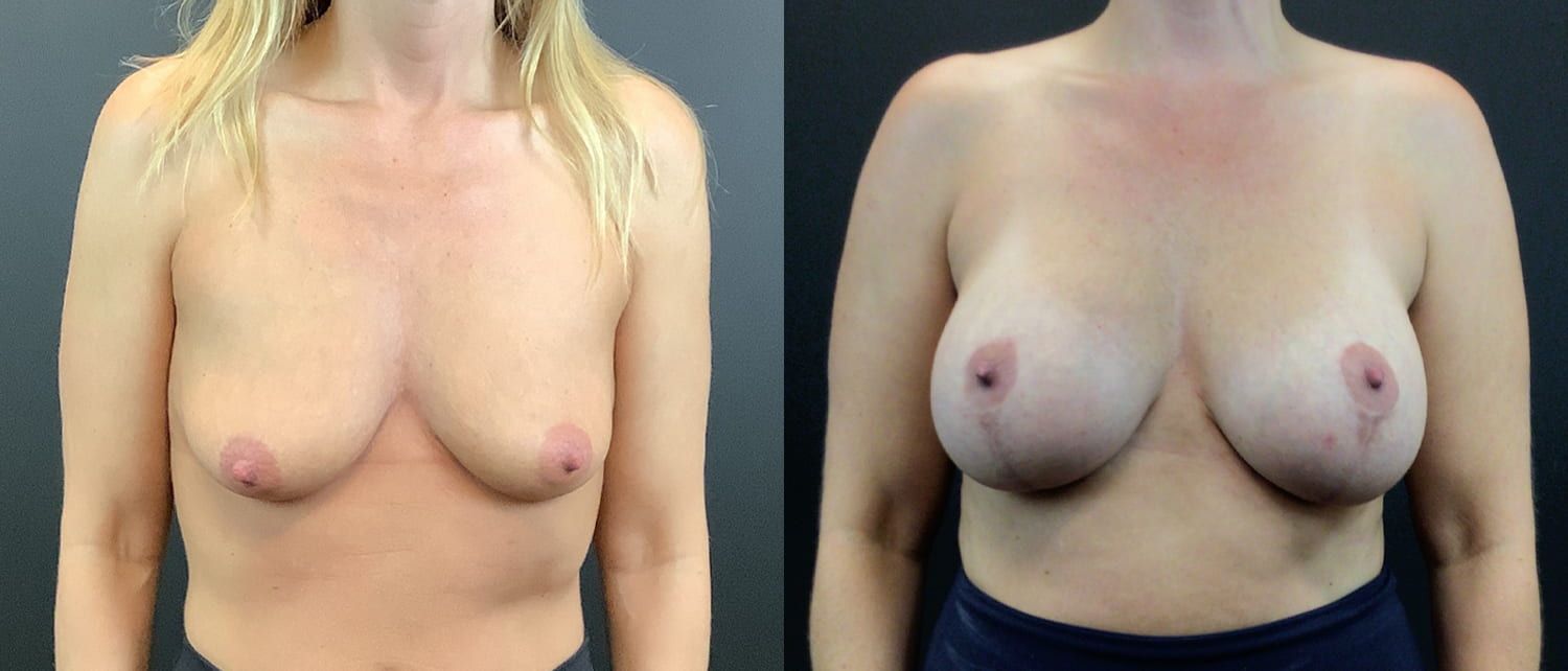 Breast Augmentation & Lift Before & After