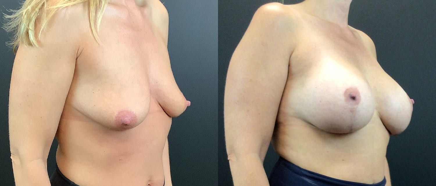 Breast Augmentation & Lift Before & After
