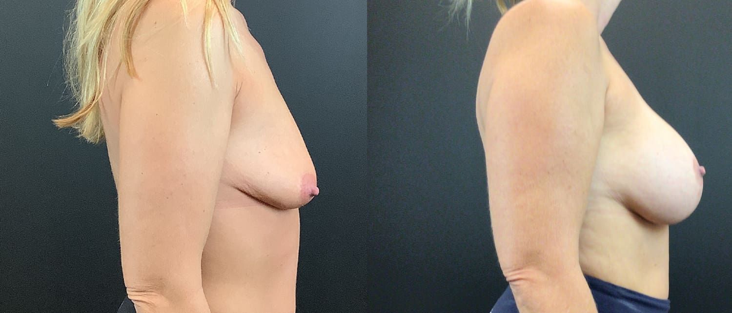 Breast Augmentation & Lift Before & After