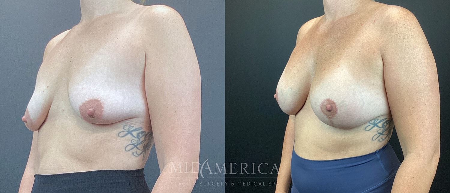 Breast Augmentation & Lift Before & After