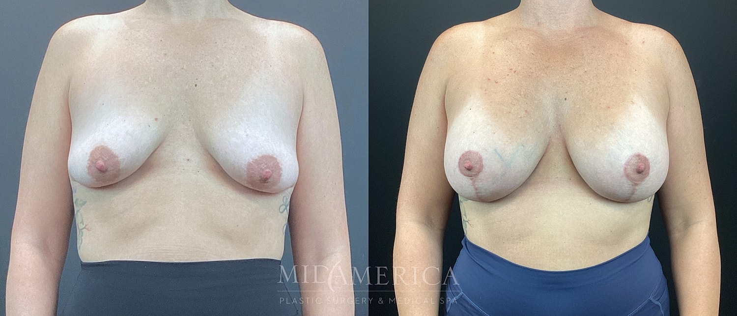 Breast Augmentation & Lift Before & After