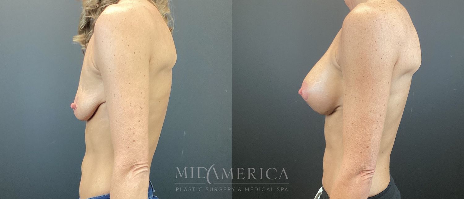 Breast Augmentation & Lift Before & After