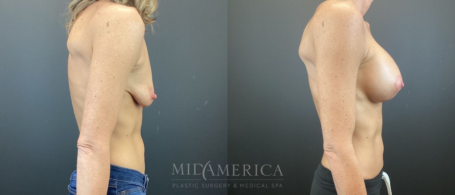 Breast Augmentation & Lift Before & After