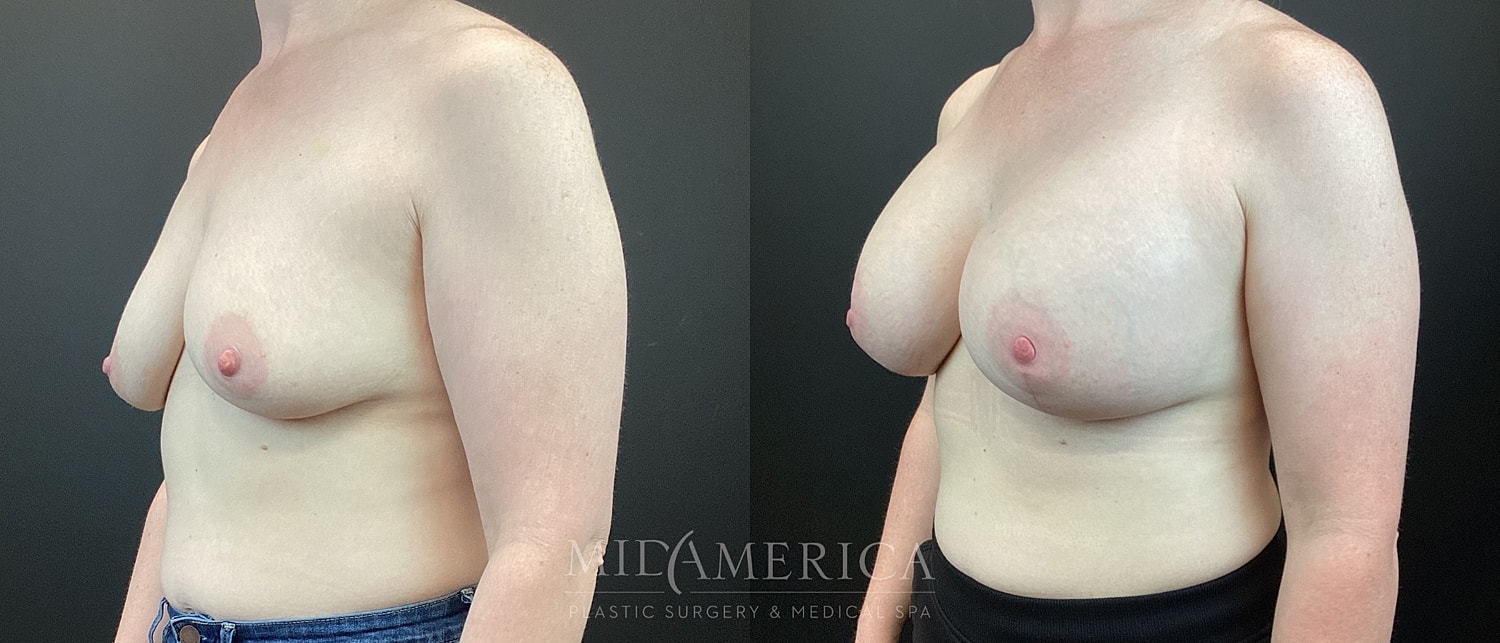 Breast Augmentation & Lift Before & After