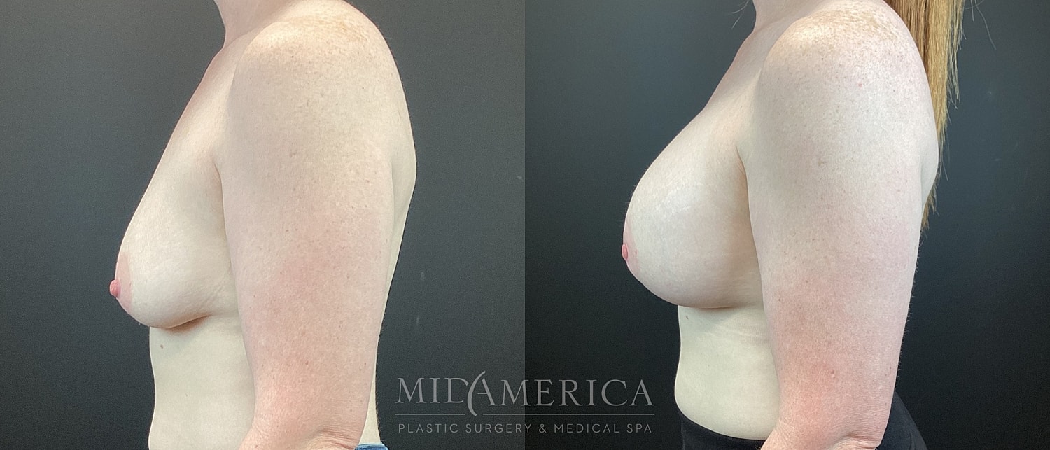 Breast Augmentation & Lift Before & After